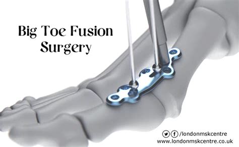 Big Toe Fusion Surgery London Musculoskeletal Centre Orthopedic