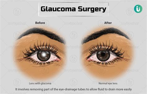 Glaucoma Surgery Procedure Purpose Results Cost Price