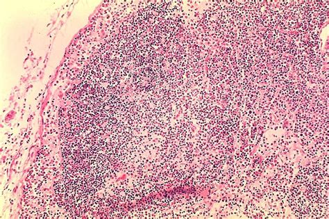 Free Picture Histopathology Lymph Node Fatal Human Plague