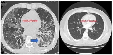 Accurate Diagnosis Of Covid 19 Using Ct Scan And Ai