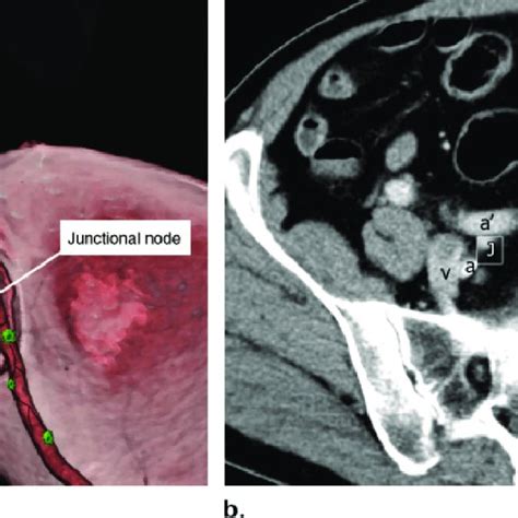 Internal Iliac Lymph Nodes Schematic A And Axial Contrast Enhanced