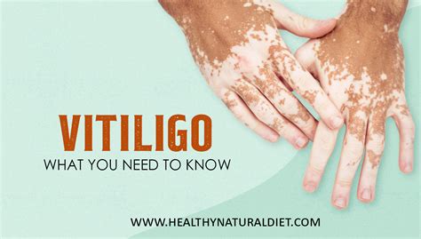 Vitiligo Symptoms Treatments Causes Tests And Preventions