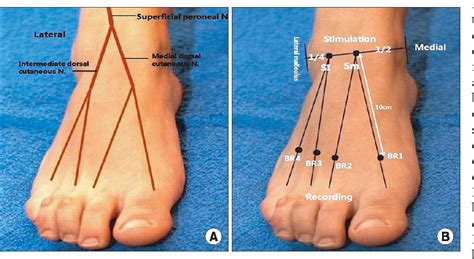 Figure From Nerve Conduction Study Of The Superficial Peroneal My Xxx