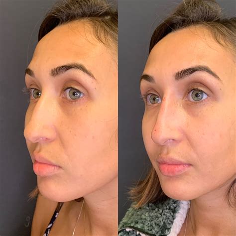 Fillers Before And After Photos Beauty Boost Medspa