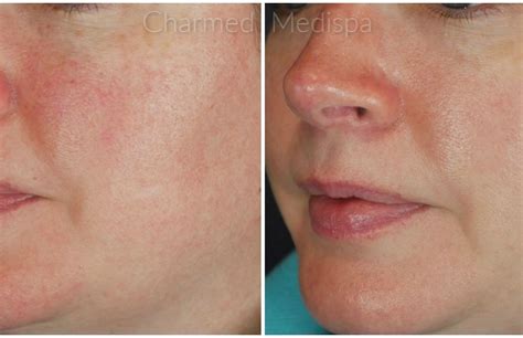 Intense Pulsed Light And Laser Therapy Charmed Medispa