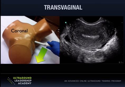 Uterus Ultrasound Transvaginal