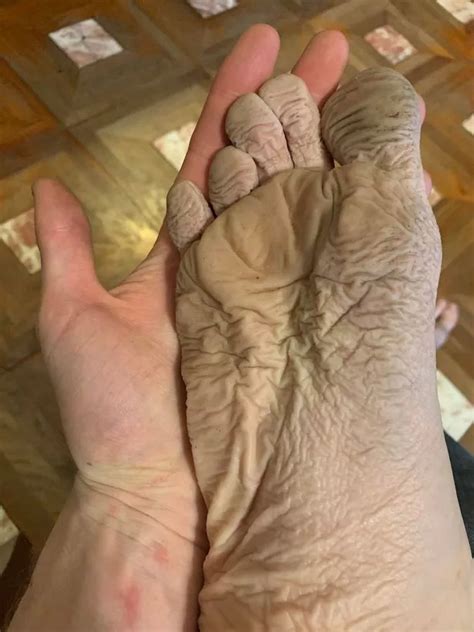 man told he has trench foot after wearing a pair of wet boots for 10 hours mirror online