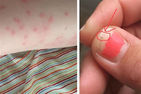 Mom Notices Tiny Black Dots Covering Her Childs Skin And Thinks