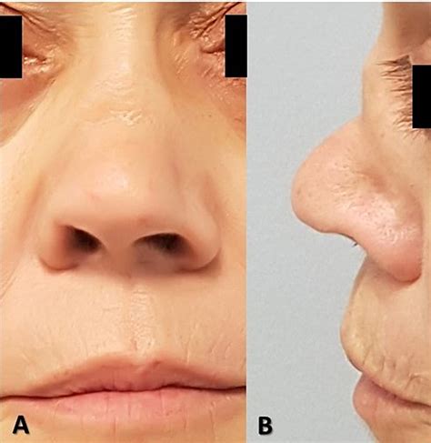 Saddle Nose Deformity Reconstruction With Autologous Costal Cartilage