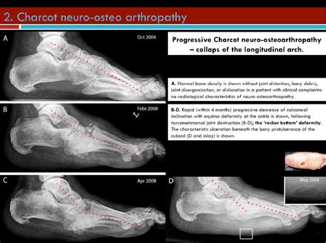 Figure 3 From Charcot Foot And Osteomyelitis In Diabetes Radiologist