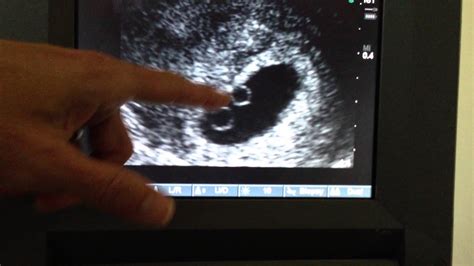 Robinson Triplets 6 Week Ultrasound Twins Youtube