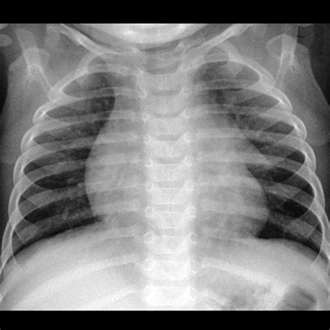 Normal Neonatal Chest X Ray My Xxx Hot Girl