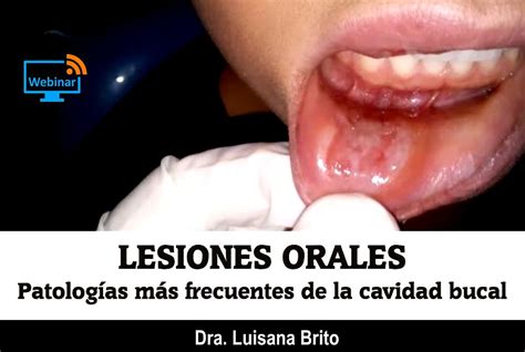 Lesiones Orales Patolog As M S Frecuentes De La Cavidad Bucal Dra