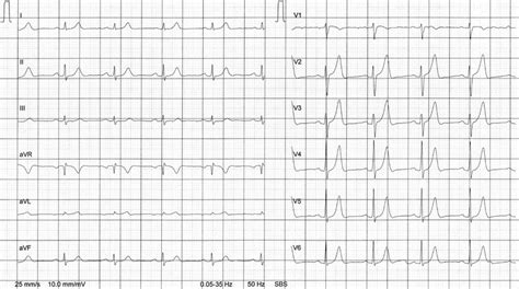 Ecg At Rest From Brother A Abbreviations Avf Augmented Unipolar Limb