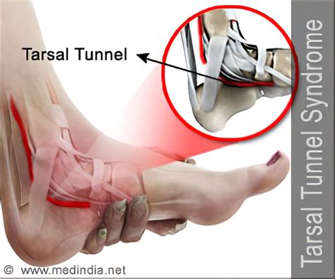 Tarsal Tunnel Syndrome Causes Symptoms Treatment Tarsal Tunnel Syndrome
