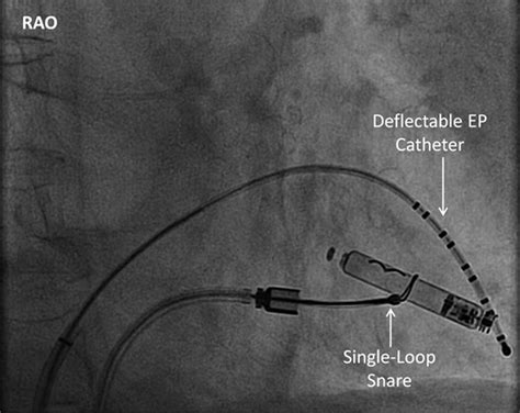 Retrieval Of The Leadless Cardiac Pacemaker Circulation Arrhythmia