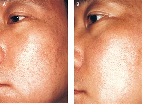 Figure 1 From Resurfacing Of Pitted Facial Acne Scars With A Long
