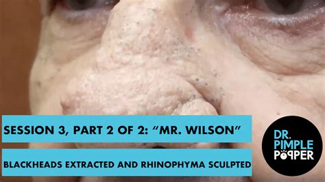 Session 3 Part 2 Of 2 Mr Wilson Blackheads Extracted And Rhinophyma Sculpted Dr Pimple Popper
