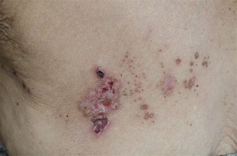 are there foods that heal shingles livestrong