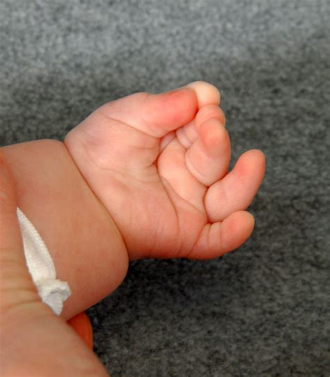 Small Finger Polydactyly Extra Fingers Congenital Hand And Arm