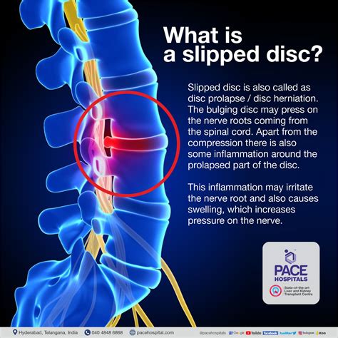 Slipped Disc Symptoms Causes And Treatment Disc Prolapse