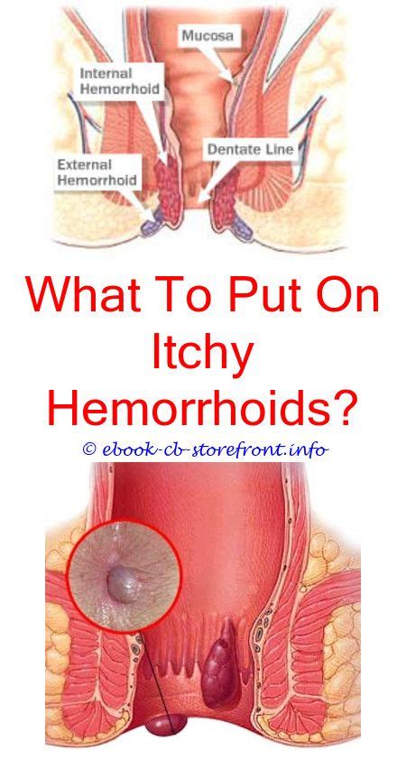 17 impressive hemorrhoid relief it works ideas external hemorrhoids cure for hemorrhoids