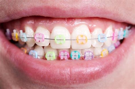 Find The Most Flattering Braces Colors For You Patchogue Ortho