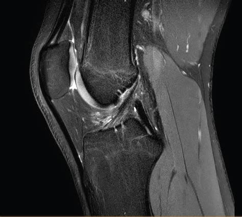 Isolated Tear Of The Distal Biceps Femoris Tendon In A Young Elite