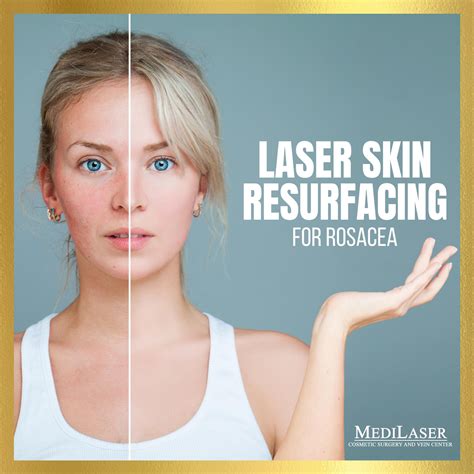 Laser Skin Resurfacing For Rosacea Medilaser Surgery And Vein Center