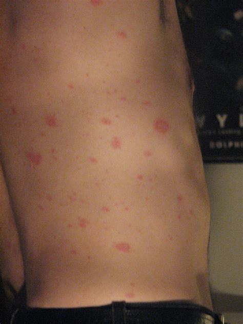 Pictures Of Pityriasis Rosea Pictures Photos
