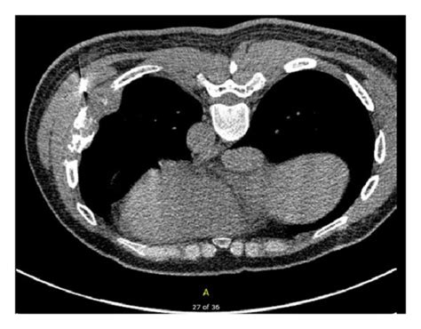 Axial Ct Chest Without Contrast Soft Tissue Views Demonstrating The