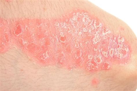 Rash 22 Common Skin Rashes Pictures Causes Treatment Artofit
