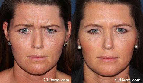 Before And After Botox And Dysport Photos San Diego Cldermatology