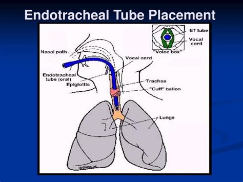 Endotracheal Tube Placement