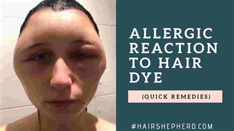 Allergic Reaction To Hair Dye Face Swelling Archives Hairshepherd