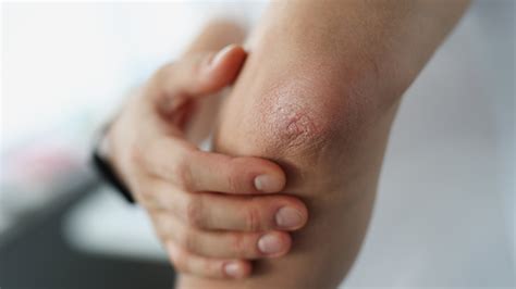This Is What Really Causes Your Dry Elbows