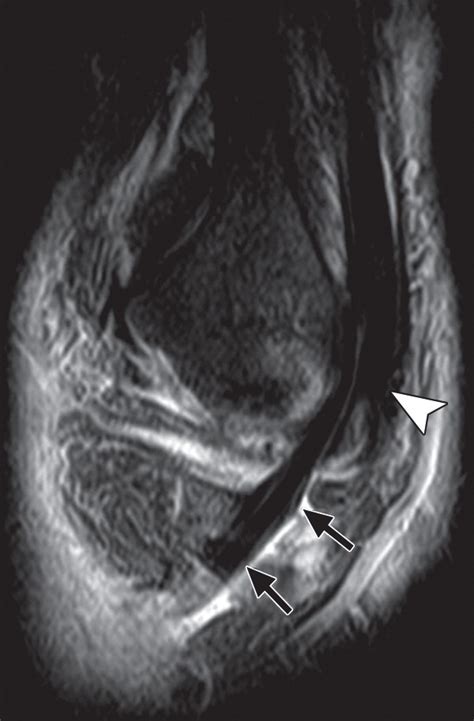 High Resolution Us And Mr Imaging Of Peroneal Tendon Injuries