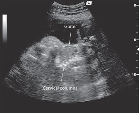 Figure 1 From Fetal Goiter And Bilateral Ovarian Cysts Semantic Scholar