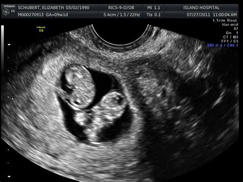 Baby Ultrasound Pictures 10 Weeks Emery Salinas