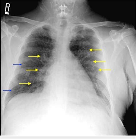 Pulmonary Congestion Chest X Ray