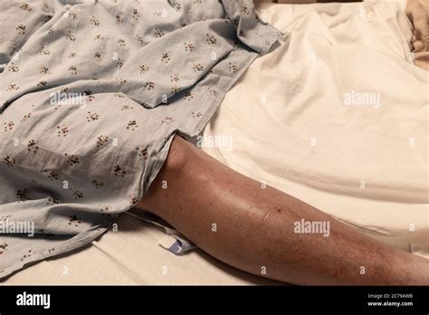 Single Leg Of An Amputee Man In A Hospital Bed Partially Covered With A