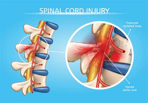 Spinal Cord Injuries Diller Law Personal Injury Law