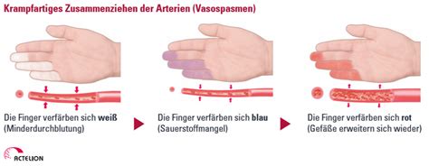 It is marked by brief episodes of narrowing of the blood vessels, reducing blood flow. Symptome - ruhig-atmen