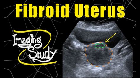 Fibroid Uterus Ultrasound Case 120 Youtube
