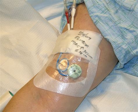 Picc Line Placement In Arm