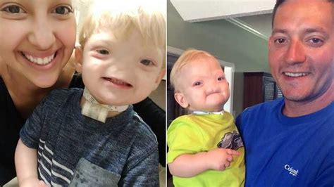 Miracle Baby Funeral Fundraiser For 2 Year Old Boy Born Without Nose