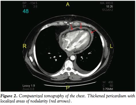 Primary Malignant Pericardial Mesothelioma Presenting As Effusive
