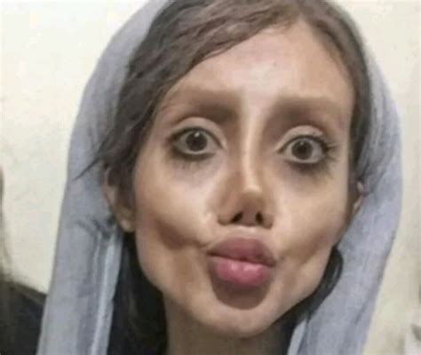 Girl Just Wants To Look Like Angelina Jolie But Surgery Went Totally