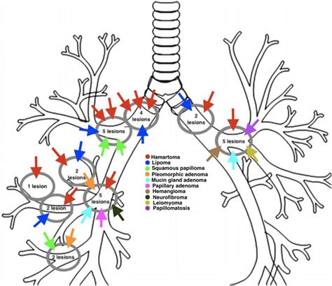 Anatomic Locations Of Benign Endobronchial Lesions Of Patients