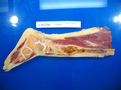 Leg Tumor Perfect Longitudinal Section After Deep Freeze